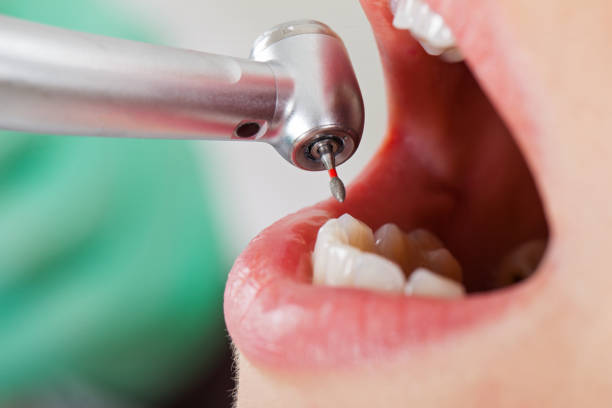 Best Emergency Dentist for Lost Fillings or Crowns in Honaker, VA